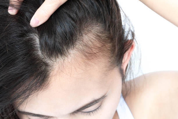 Understanding Thinning Hair: Causes, Solutions, And Prevention Tips