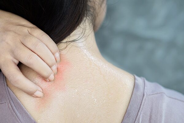 FAQs about summer skin problems