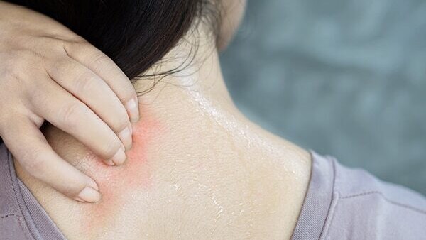 FAQs about summer skin problems
