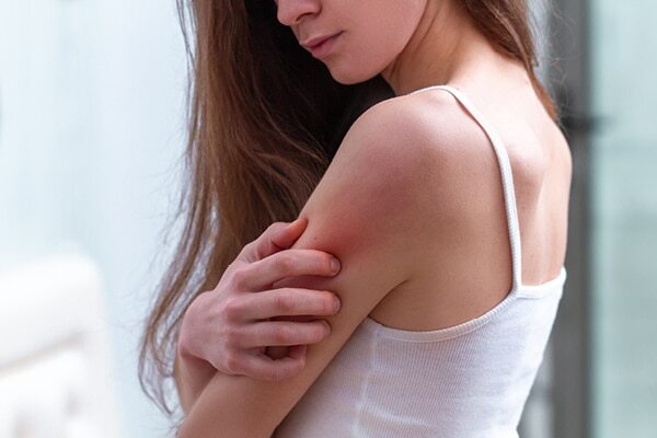 FAQs about summer skin problems