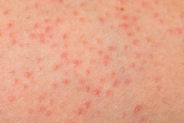 FAQs about summer skin problems