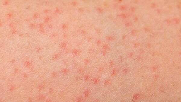 FAQs about summer skin problems