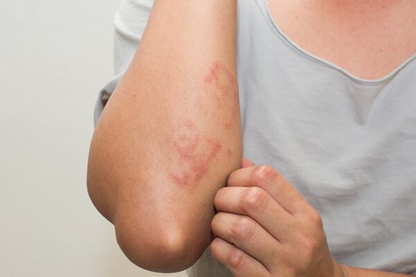 FAQs about summer skin problems