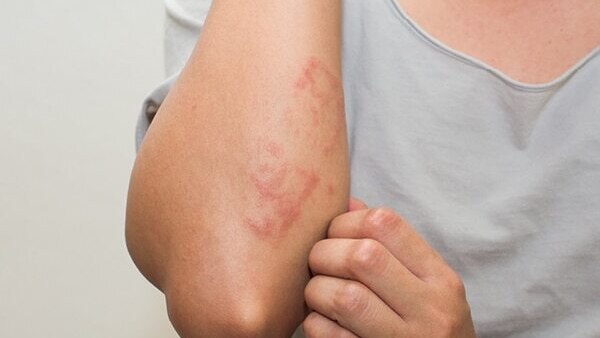 FAQs about summer skin problems