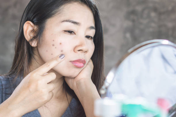 Ultimate Guide To Removing Black Spots On YourFace