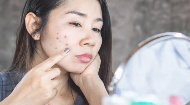 Ultimate Guide To Removing Black Spots On YourFace