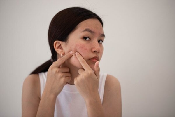 Proven Pimple Removal Methods For Clear Skin