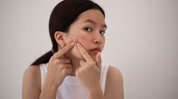 Proven Pimple Removal Methods For Clear Skin