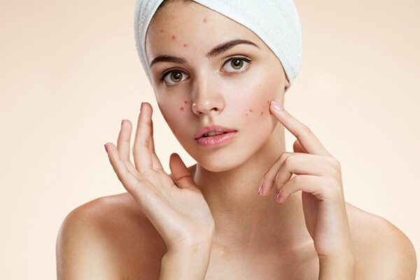 FAQs about coconut oil for acne