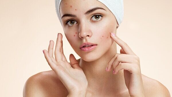 FAQs about coconut oil for acne