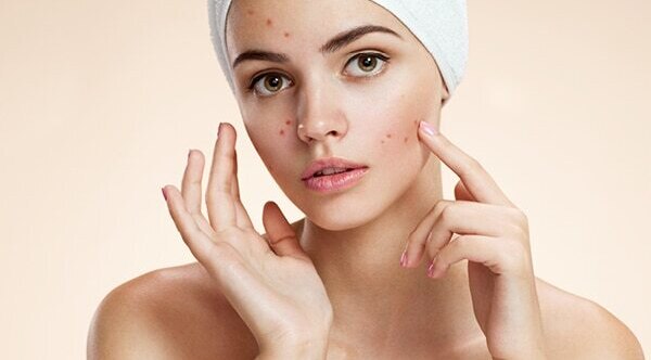 FAQs about coconut oil for acne