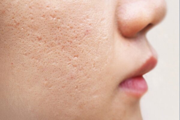 May reduce stretch marks