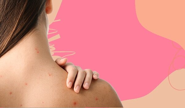 The Most Effective Ways to Get Rid Of Back Acne