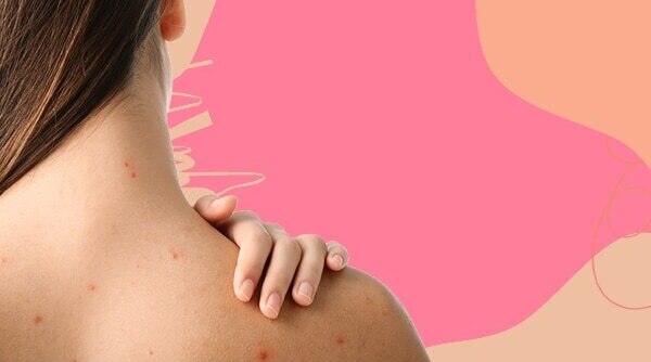 The Most Effective Ways to Get Rid Of Back Acne