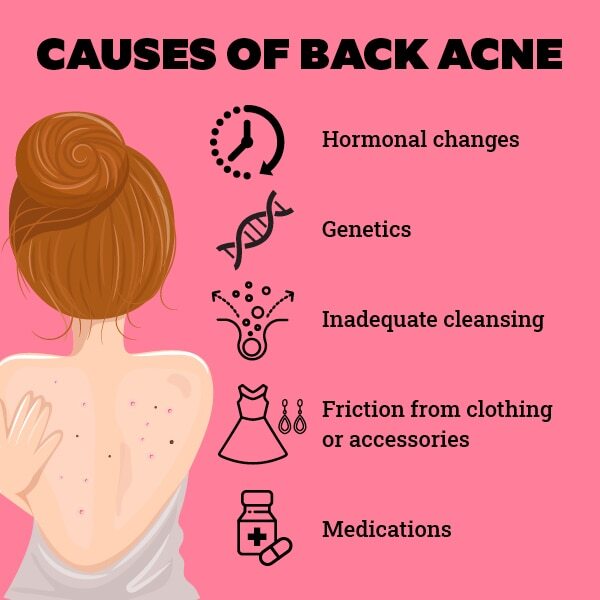 FAQs about back acne