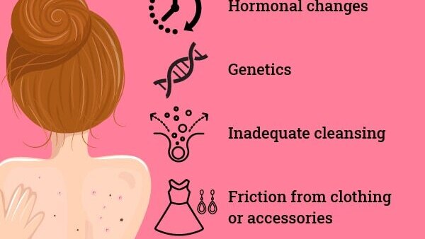 FAQs about back acne
