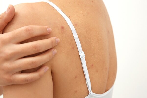 FAQs about back acne