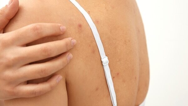 FAQs about back acne