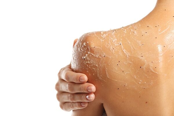 FAQs about back acne