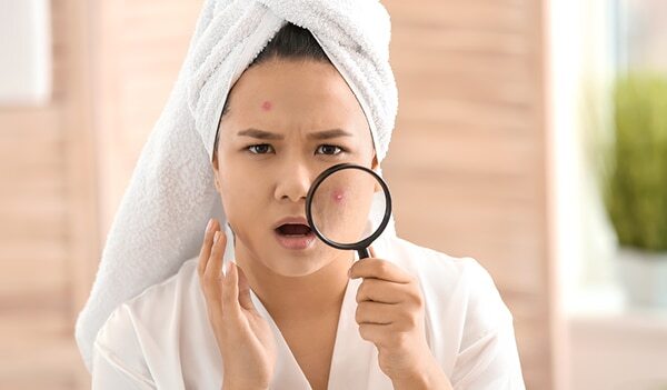 Period Acne Troubling You? Here's A Guide To Help You Deal With It
