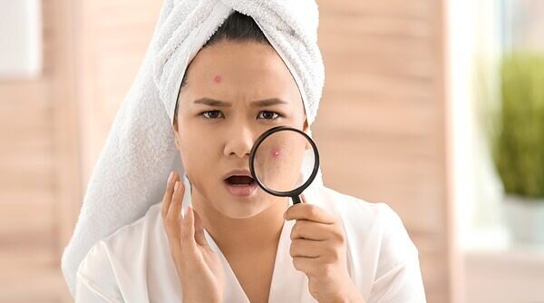 Period Acne Troubling You? Here's A Guide To Help You Deal With It