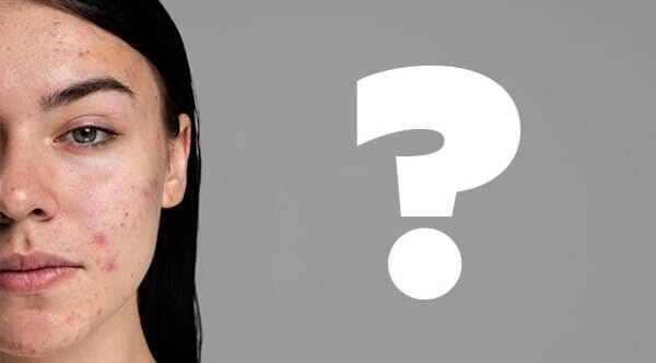 FAQs about Acne Prone Skin