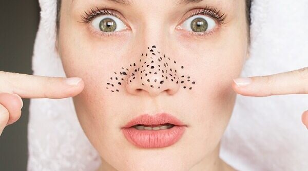 Blackheads Annoying You Here Are 10 Reliable Ways To Remove Blackheads
