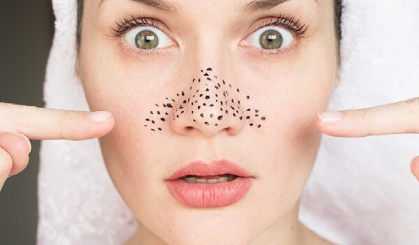 Blackheads Annoying You Here Are 10 Reliable Ways To Remove Blackheads