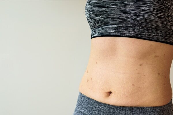 FAQs about lichen planus