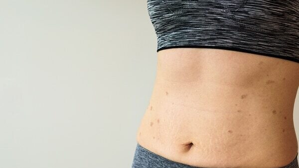 FAQs about lichen planus