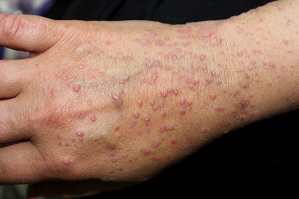 FAQs about lichen planus
