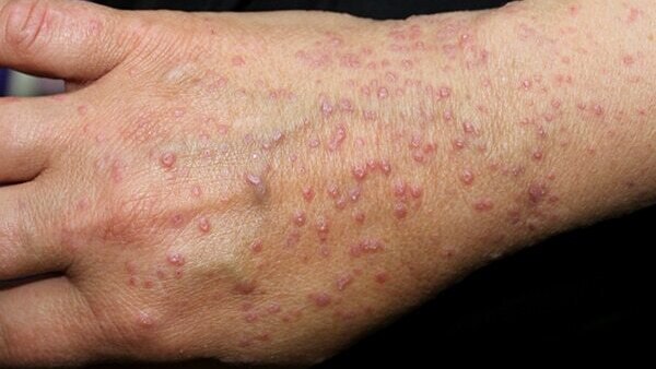 FAQs about lichen planus