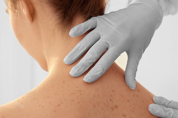 FAQs about lichen planus