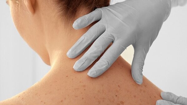 FAQs about lichen planus