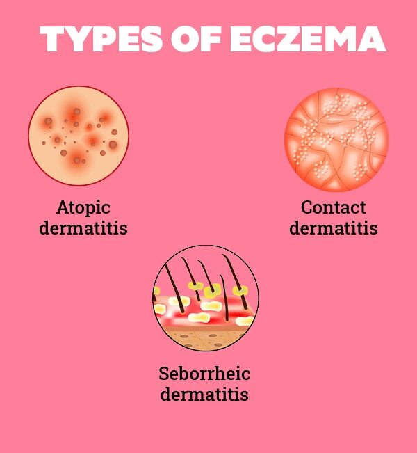 Eczema on the face: How to take care of the skin?