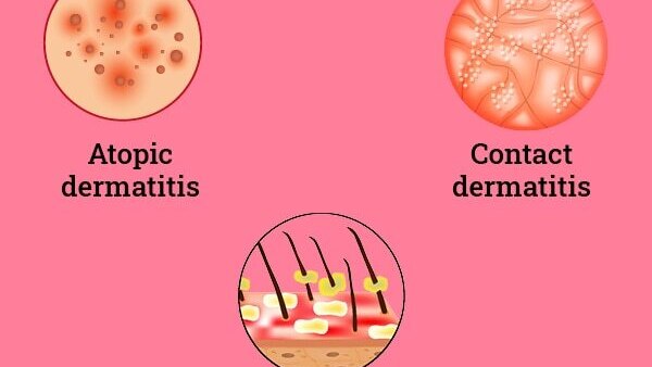 Eczema on the face: How to take care of the skin?