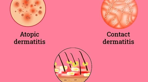 Eczema on the face: How to take care of the skin?