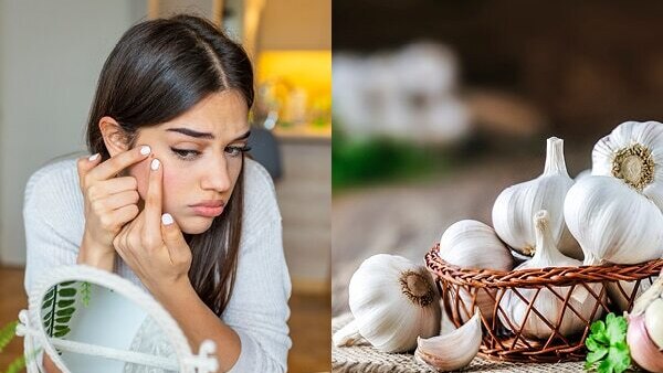 How to Prevent Pimples & Acne