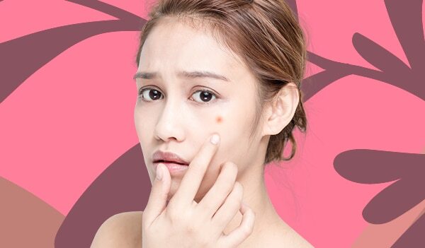 How To Use Witch Hazel To Tackle Acne-Prone Skin