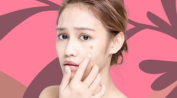 How To Use Witch Hazel To Tackle Acne-Prone Skin