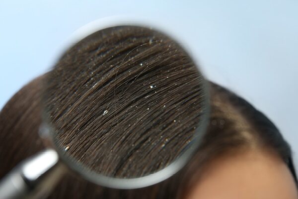 FAQ on Aloe Vera For Dandruff