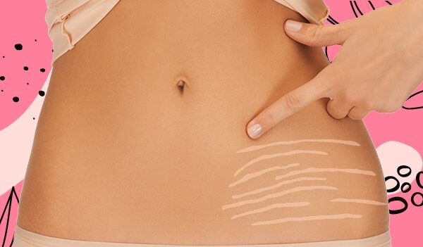 How To Deal With Stretch Marks In Teenagers, According To a Dermatologist