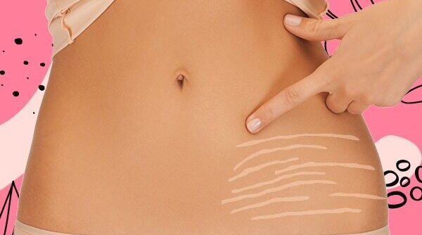 How To Deal With Stretch Marks In Teenagers, According To a Dermatologist