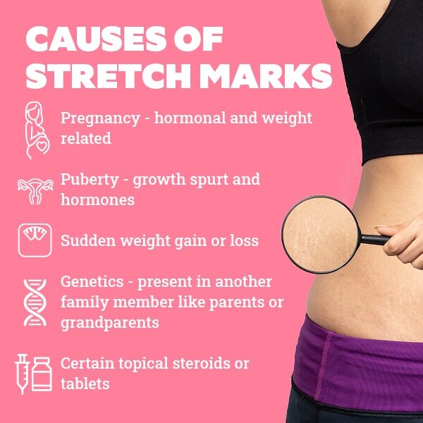 FAQs about stretch marks in teenagers