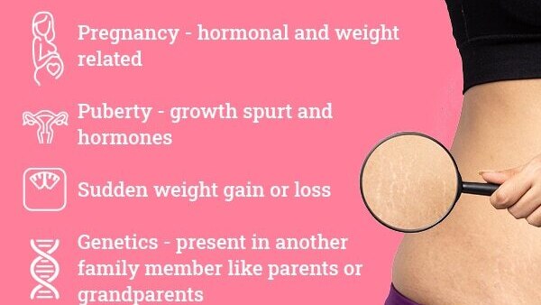 FAQs about stretch marks in teenagers