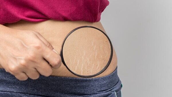 FAQs about stretch marks in teenagers