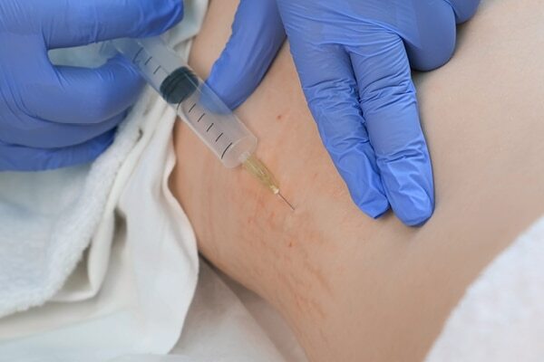FAQs about stretch marks in teenagers