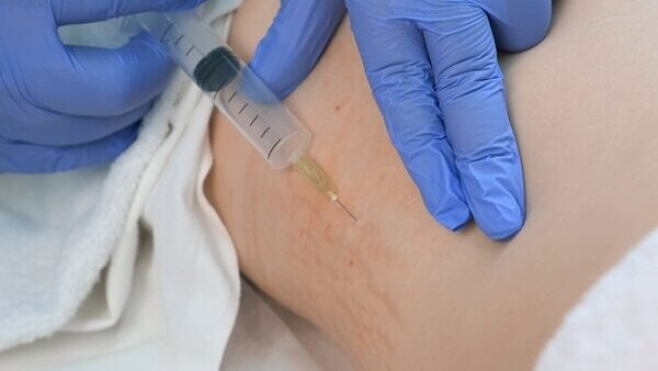 FAQs about stretch marks in teenagers