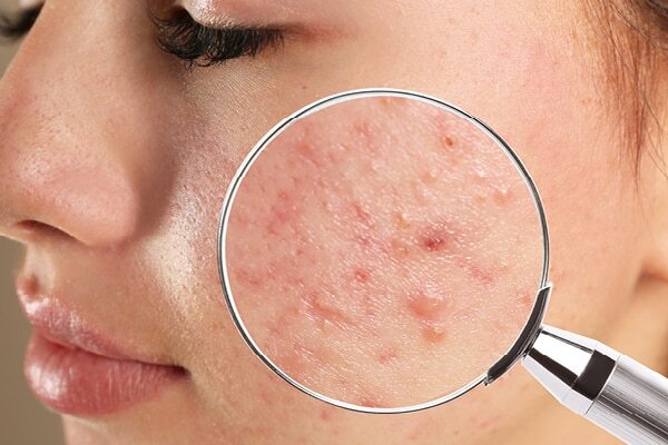Cold sores - Common types of skin lesions