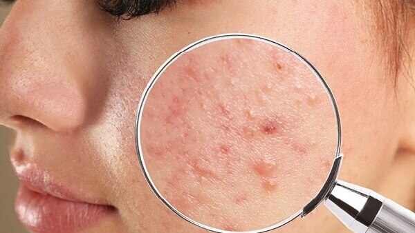 Cold sores - Common types of skin lesions